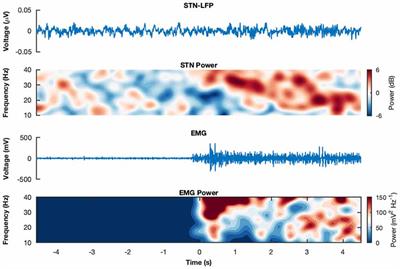 Levodopa Modulates Functional Connectivity in the Upper Beta Band Between Subthalamic Nucleus and Muscle Activity in Tonic and Phasic Motor Activity Patterns in Parkinson’s Disease